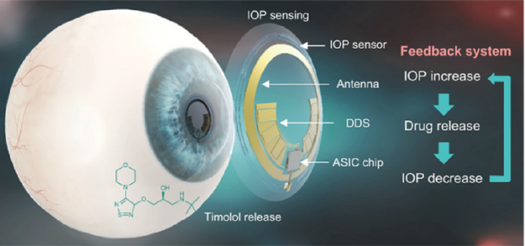 Lente de contacto inteligente diagnostica e trata o glaucoma