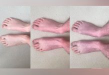 "Pernas e pés azuis": um sintoma da COVID longa