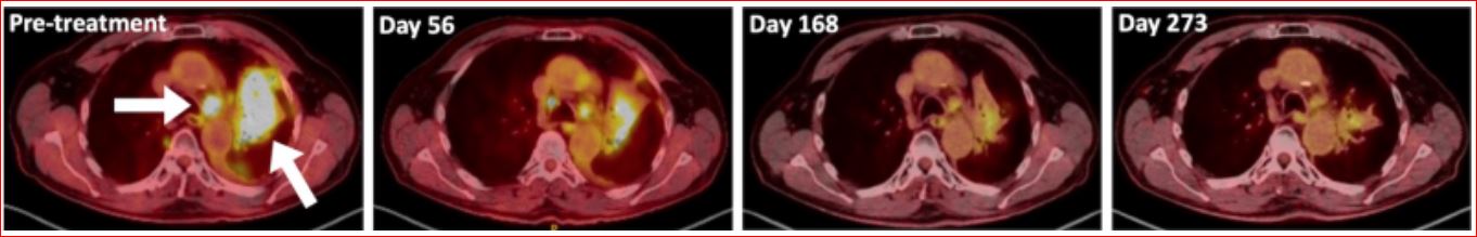 Exames de tórax mostrando tumores pulmonares em paciente com cancro do pulmão de células não pequenas metastático antes e depois de receber dupilumab com imunoterapia convencional. Credito: LaMarche et al., Nature.