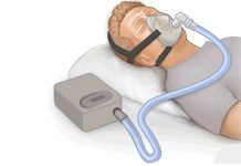 Nova ferramenta prevê como uso de CPAP afeta risco de doenças cardiovasculares em pacientes com apneia obstrutiva do sono
