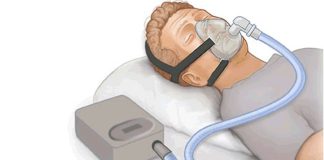 Nova ferramenta prevê como uso de CPAP afeta risco de doenças cardiovasculares em pacientes com apneia obstrutiva do sono
