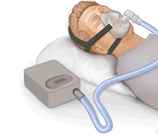 Nova ferramenta prevê como uso de CPAP afeta risco de doenças cardiovasculares em pacientes com apneia obstrutiva do sono